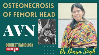 OSTEONECROSIS OF FEMORAL HEAD  AVASCULAR NECROSIS OF FEMORAL HEAD  AVN [upl. by Rotman]