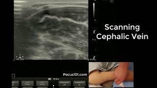 Scanning the Cephalic Vein with Ultrasound [upl. by Adnale130]