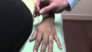 How To Manipulate an Acupuncture Needle  Oriental Medicine with Dr Justin Newman [upl. by Retniw]