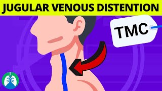 What are the Causes of Jugular Venous Distention JVD  TMC Practice Question [upl. by Watkin]