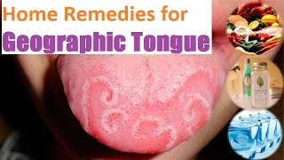 5 Home Remedies for Geographic Tongue  By Top 5 [upl. by Kevina228]