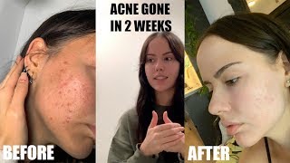 10 YEARS OF ACNE GONE IN 2 WEEKS [upl. by Krebs]