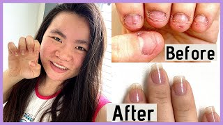 How I Stopped Biting My Nails For GOOD in 2020 nail journey part 4 [upl. by Yrakcaz]