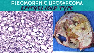 Pleomorphic liposarcoma epithelioid type Oregon Case 15 pathology sarcoma spindle cell neoplasm [upl. by Aliekahs]