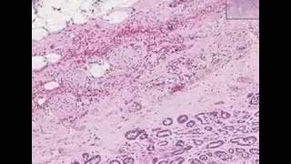 Histopathology Prostate Adenocarcinoma Gleason grade 3 [upl. by Ylime]