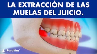 Extracción de muelas del juicio y pericoronatis  ¿Por qué se extraen las cordales © [upl. by Jayme]