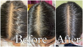 My Honest Hair loss Journey amp How I fixed it [upl. by Nnairret]