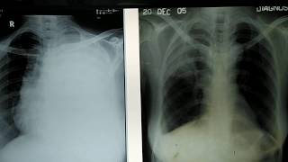 X Ray Chest  Pleural Effusion Vs Pulmonary Fibrosis  How to differentiate  MBBS final [upl. by Retepnhoj]