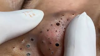 Treatment of Blackheads and Hidden Acne at Loan Nguyen Spa  031 [upl. by Lundeen]