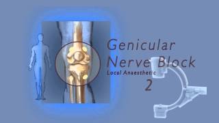 Genicular nerve block by Dr Murli Krishna Pain Specialist Bristol [upl. by Nodababus]