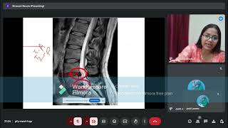 Prolapsed Intervertebral Disc Anatomy of IV Disc Part 2 [upl. by Ennayd]