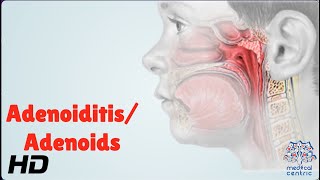 AdenoiditisAdenoids Everything You Need To Know [upl. by Wesa]