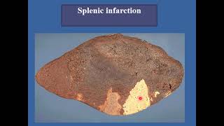 haemodynamic disorders infarction gangrene Hyperaemia level 1 2024 [upl. by Rednaeel]