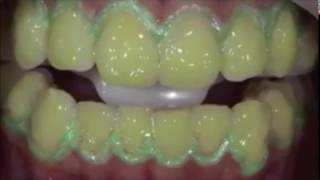 Teeth Whitening Procedure Step by Step [upl. by Fredericka]