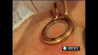 Traitement de lésions vasculaire du visage couperose par laser  CLME Montlhéry Essonne [upl. by Eramat974]