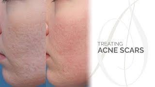 Treating Acne Scars [upl. by Truelove]