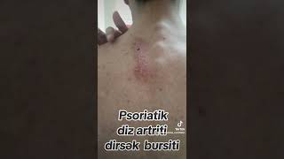 psoriatikartrit psoriaz dizartriti dirsəkartriti [upl. by Nylrahc]