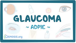 Glaucoma Nursing Process [upl. by Em]