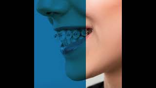 Braces vs Aligners  which Is Best [upl. by Minetta]