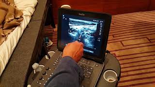 Ultrasound guided stellate ganglion block by Rafael Blanco at JCRAC19 [upl. by Marjana]