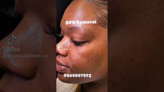 DPN removal skincaretips warts skintags moleremoval [upl. by Edlihtam]