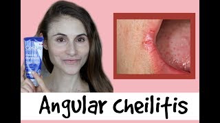 Angular cheilitis causes amp treatments a QampA with dermatologist Dr Dray [upl. by Oleic]