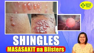 MASAKIT na Blisters Dulot ng SHINGLES  Varicella Zoster Virus  Tagalog Health Tips  Nurse Dianne [upl. by Tirrell532]