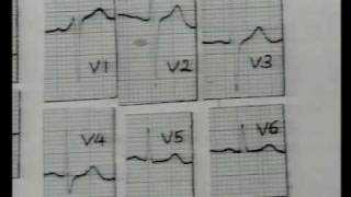 How to read an ECG [upl. by Lynnelle]