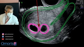 GÊMEOS Gestação inicial Ultrassonografia [upl. by Nagar]