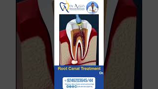 Root Canal Procedure [upl. by Gredel]