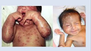 Lecture 205 Dermatoses of the Neonates Part3 Rook 10th ed Ch114 [upl. by Gerlac]