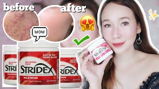 BEST amp EFFECTIVE SALICYCLIC ACID FOR ACNE PRONE SKIN STRIDEX TONER PADS REVIEW PHILIPPINES [upl. by Hgielime172]