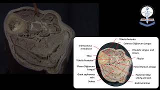 Lower Limb Cross Section at Mid Leg Level  Dr Sajith Edirisinghe [upl. by Anigger]