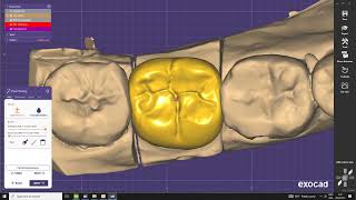 Crown Design in Exocad [upl. by Remsen]