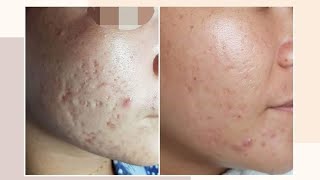 REAL and LEGIT ACNE SCARS TREATMENT SOLUSYON SA ACNE SCARS  ACNE SCAR REMOVAL AcneScarJourney [upl. by Micah]