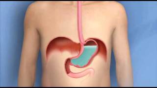 Heartburn Acid Reflux GERDMayo Clinic [upl. by Addy]