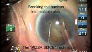 Phacoemulsification in advanced cataract with hard brown grade V nucleus [upl. by Kape543]