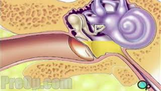 Myringotomy Insertion of Tube Surgery PreOp® Patient Education [upl. by Charry798]