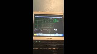 Philips IntelliVue MP70 ECG with extrasystoles [upl. by Ehc]