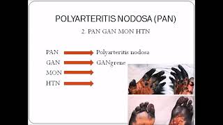 Polyarteritis Nodosa Microscopic Polyangitis amp HSP  VASCULITIS  PATHOLOGY SKY MEDICAL MNEMONICS [upl. by Ethelin]