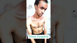 Tinea Corporis  Testimonial  Dhaka Dermatology Institute [upl. by Angelita]