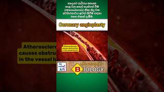 Coronary angioplasty  Medical biology  අපි නොදන්න Biology  4 🫀 biology angioplasty medical [upl. by Publias]