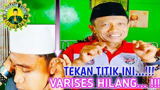 TEKAN TITIK INI VARISES JADI HILANG [upl. by Whiteley608]