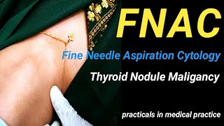 Fineneedle Aspiration Cytology in the Diagnosis of Thyroid Nodule Maligancy।। [upl. by Vick]