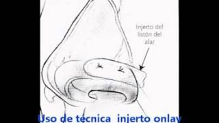 Rinoplastia funcional colapso alar técnica Onlay realizada por el Dr Monsalve [upl. by Eelannej]