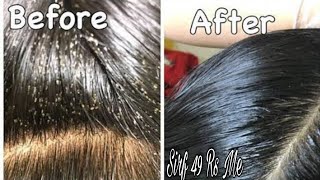 Remove 100 Lice amp Eggs Permanently with Hair Sheild Anti lice Cream 49 Rs  Farha KHan [upl. by Easlehc136]