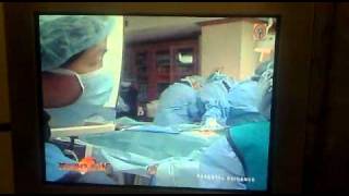 1st Percutaneous Closure of PFO part 4 of 5 [upl. by Armilla]