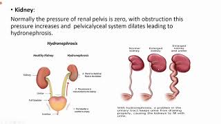 Obstructive Uropathy  Clinical  Surgery [upl. by Orelle498]