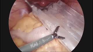 Ovarian Cystectomy for Dermoid Cyst Dr Alpa Khakhar Apollo Chennai [upl. by Alfeus]