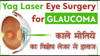 Yag Laser treatment  Laser Iridotomy for Glaucoma  काले मोतिये का लेजर से इलाज [upl. by Nnadroj]